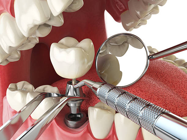 Best Emergency Root Canal Treatment in Manchester, OH